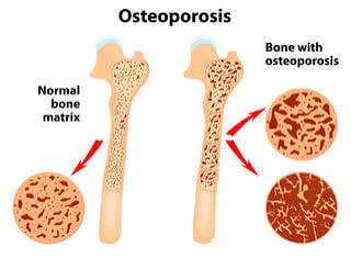 What Happens Inside Your Bones During Menopause?